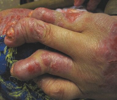 psoriasis négligé sur les mains
